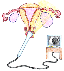 図（1）　経膣超音波検査