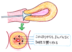 図（4）　ブラシ法による子宮頸部からの細胞採取