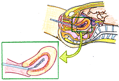図（7）　子宮内膣からの細胞採取